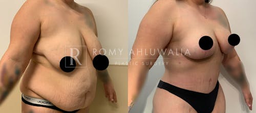 Before & After Result of Tummy Tuck Patient #100