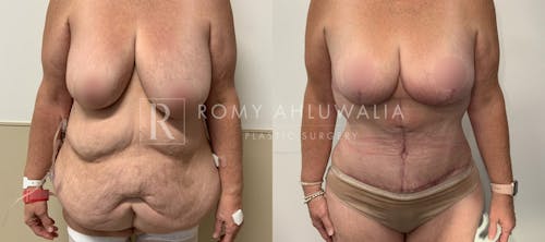 Before & After Result of Tummy Tuck Patient #101