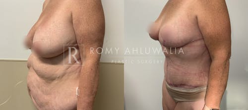 Before & After Result of Tummy Tuck Patient #101
