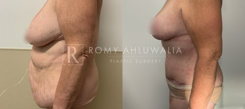 Before & After Result of Tummy Tuck Patient #101