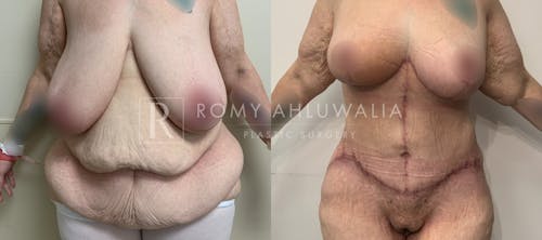 Before & After Result of Tummy Tuck Patient #102
