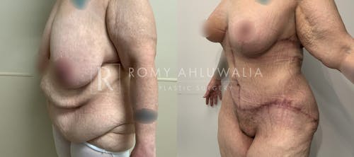 Before & After Result of Tummy Tuck Patient #102