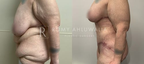 Before & After Result of Tummy Tuck Patient #102