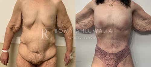 Before & After Result of Tummy Tuck Patient #103