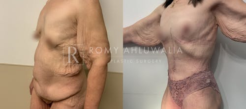 Before & After Result of Tummy Tuck Patient #103