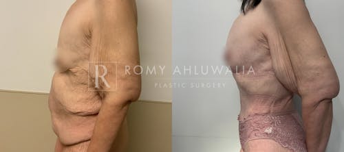 Before & After Result of Tummy Tuck Patient #103