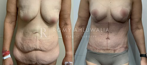 Before & After Result of Tummy Tuck Patient #104