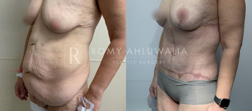 Before & After Result of Tummy Tuck Patient #104