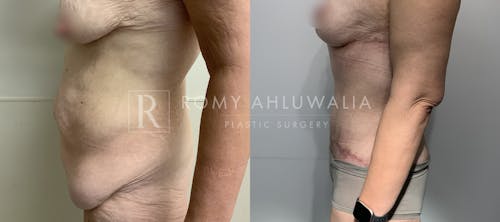 Before & After Result of Tummy Tuck Patient #104
