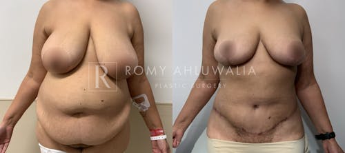 Before & After Result of Tummy Tuck Patient #105