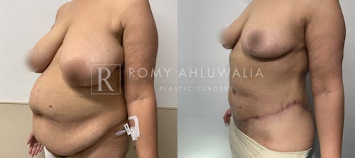 Before & After Result of Tummy Tuck Patient #105