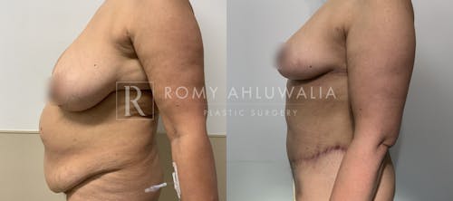 Before & After Result of Tummy Tuck Patient #105