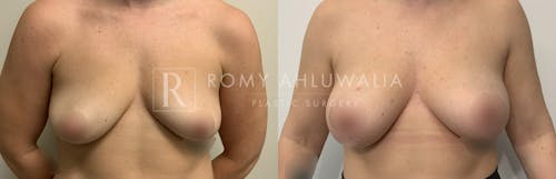 Before & After Result of Breast Augmentation Patient #25