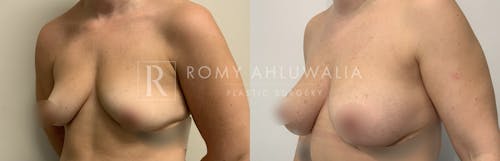 Before & After Result of Breast Augmentation Patient #25