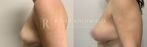 Before & After Result of Breast Augmentation Patient #25