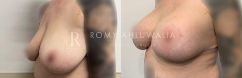 Before & After Result of Breast Augmentation With Lift Patient #4