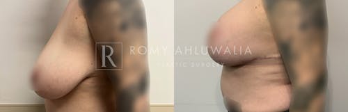 Before & After Result of Breast Augmentation With Lift Patient #4