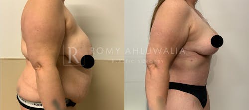 Before & After Result of Tummy Tuck Patient #100