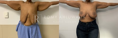 Before & After Result of Arm Lift Patient #6