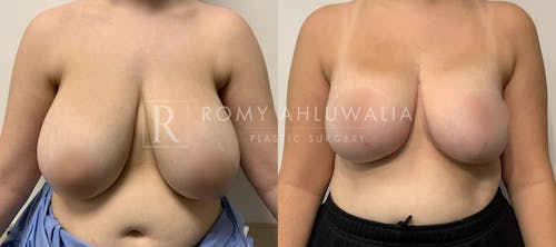 Before & After Result of Breast Reduction Patient #45