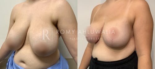 Before & After Result of Breast Reduction Patient #45