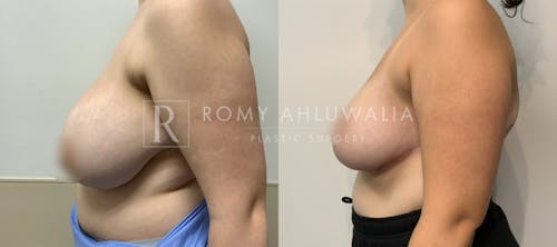 Before & After Result of Breast Reduction Patient #45