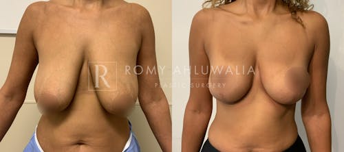 Before & After Result of Breast Reduction Patient #46