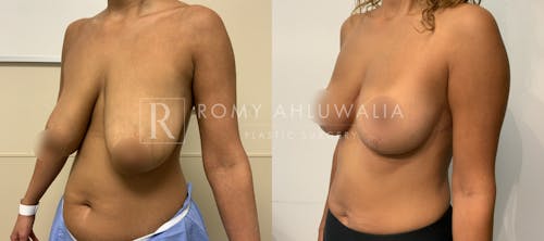 Before & After Result of Breast Reduction Patient #46