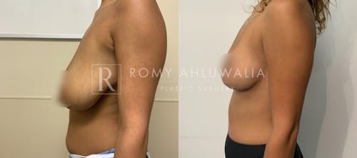 Before & After Result of Breast Reduction Patient #46