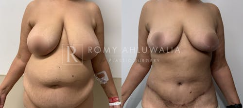 Before & After Result of Breast Reduction Patient #47