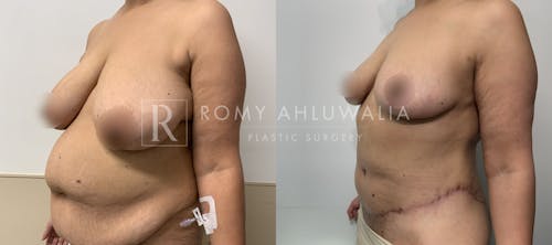 Before & After Result of Breast Reduction Patient #47