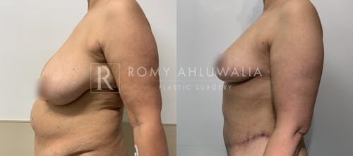 Before & After Result of Breast Reduction Patient #47