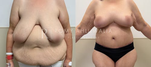 Before & After Result of Breast Reduction Patient #48
