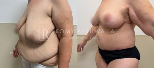 Before & After Result of Breast Reduction Patient #48