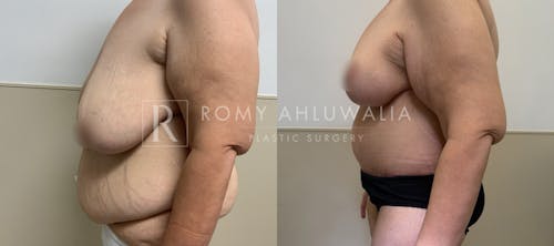 Before & After Result of Breast Reduction Patient #48