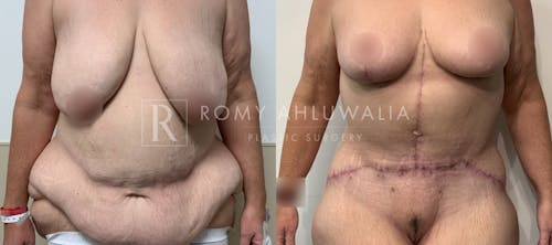 Before & After Result of Breast Reduction Patient #49