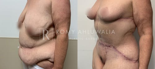 Before & After Result of Breast Reduction Patient #49