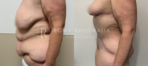 Before & After Result of Breast Reduction Patient #49