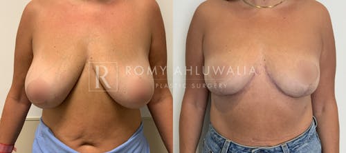 Before & After Result of Breast Reduction Patient #50
