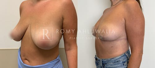 Before & After Result of Breast Reduction Patient #50
