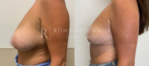 Before & After Result of Breast Reduction Patient #50