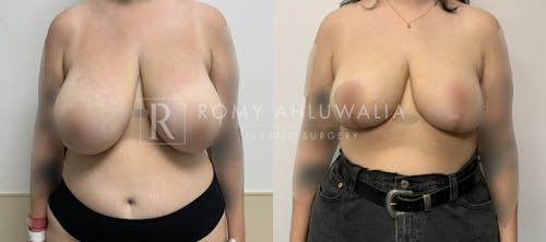 Before & After Result of Breast Reduction Patient #51