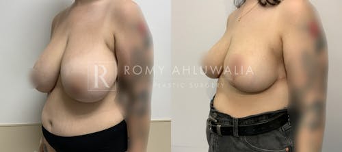 Before & After Result of Breast Reduction Patient #51