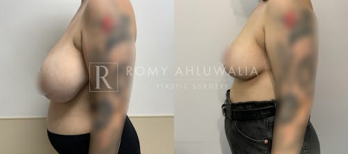 Before & After Result of Breast Reduction Patient #51