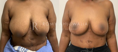 Before & After Result of Breast Reduction Patient #52