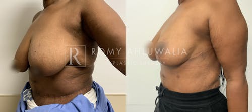 Before & After Result of Breast Reduction Patient #52