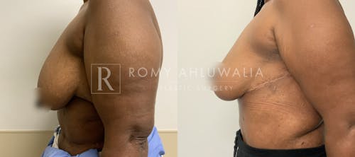 Before & After Result of Breast Reduction Patient #52