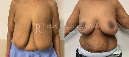 Before & After Result of Breast Reduction Patient #53