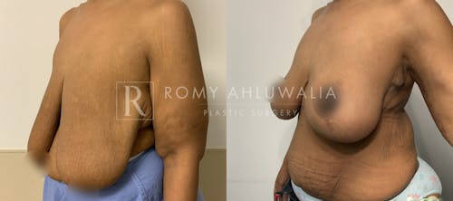 Before & After Result of Breast Reduction Patient #53