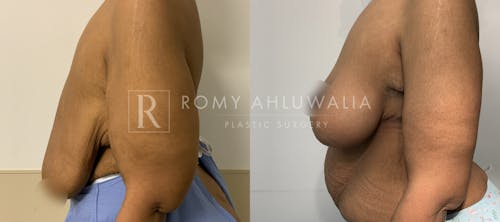 Before & After Result of Breast Reduction Patient #53